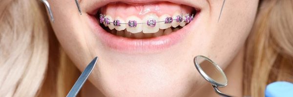 Benefits-of-visiting-an-Orthodontists