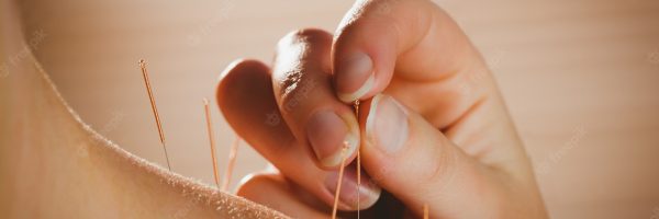 young-woman-getting-acupuncture-treatment_13339-270618